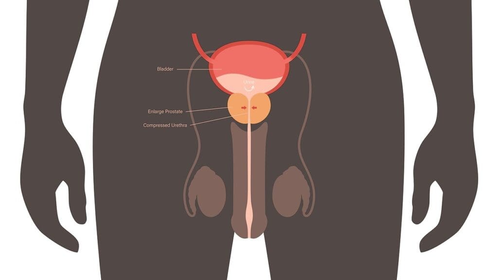 What Happens When Prostate Cancer Comes Back After Radiation Therapy?