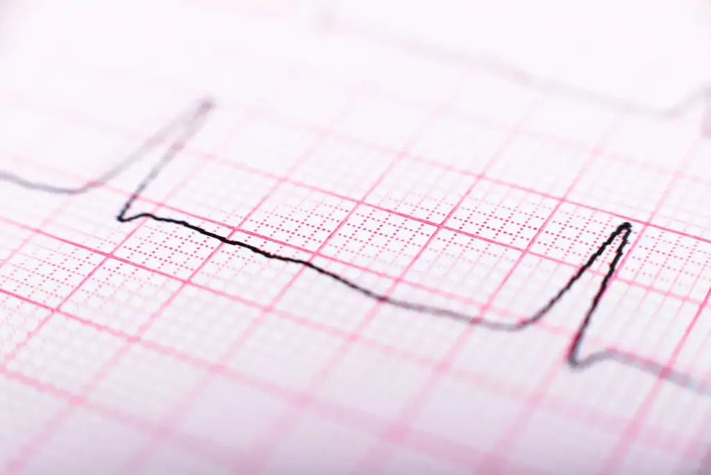 What Is Irregular Sinus Rhythm?
