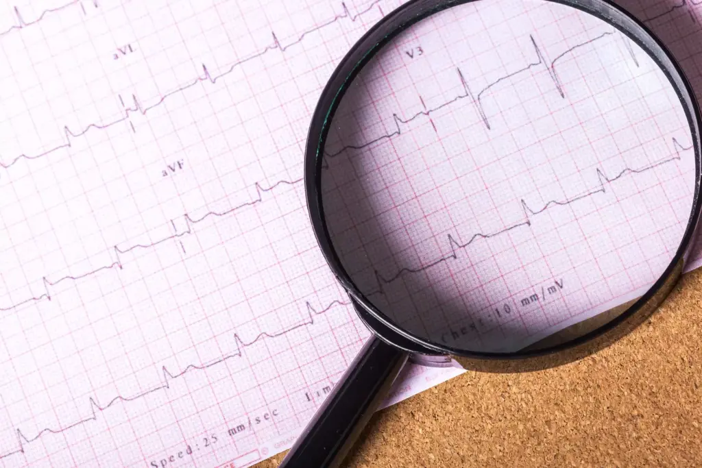What Is Sinus Arrhythmia? What Is Sinus Arrhythmia?