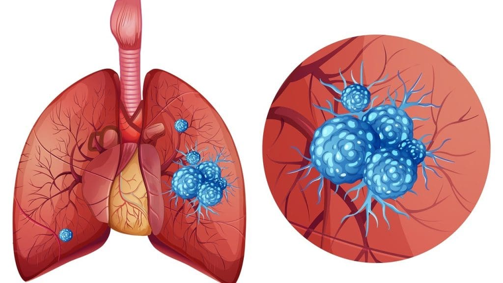 What is Graft Versus Host Disease