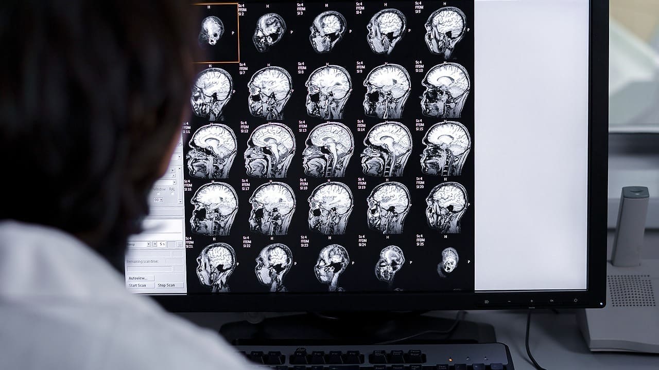 abnormal mri of brain