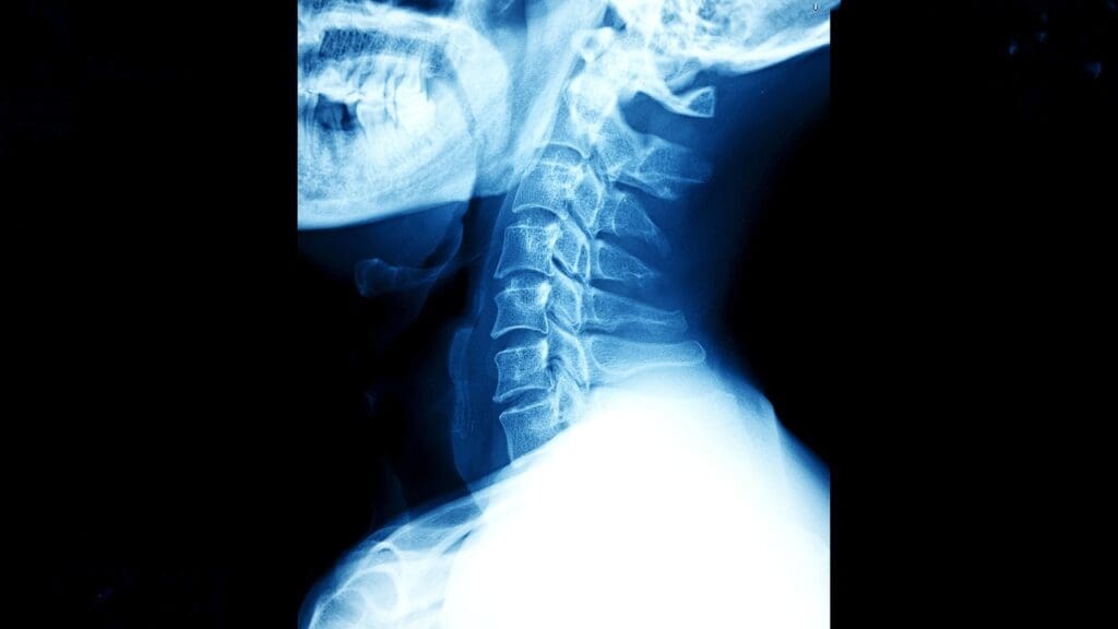 acdf spine fusion acdf spine fusion