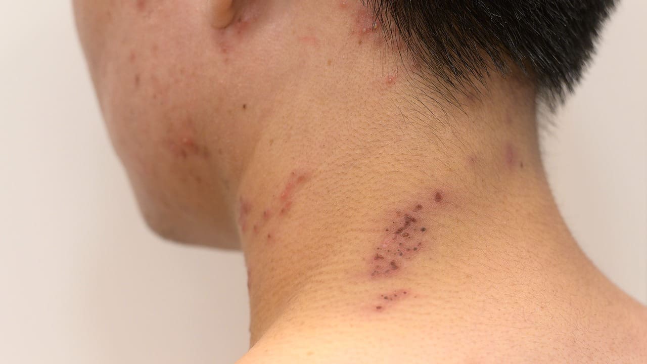 acdf surgery scar