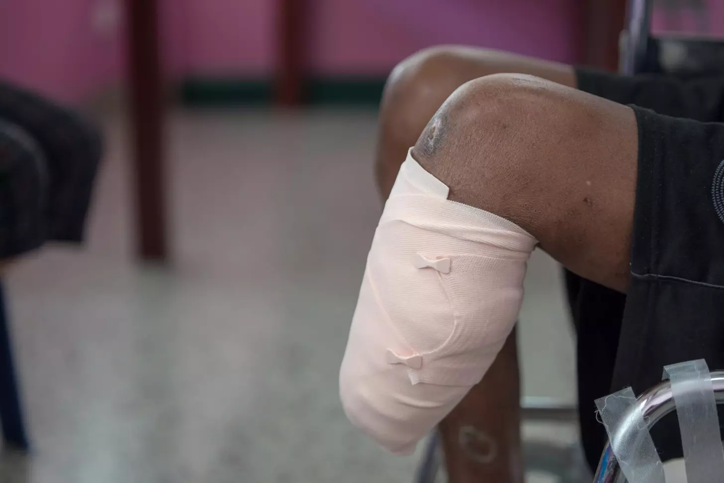 acl surgery recovery time