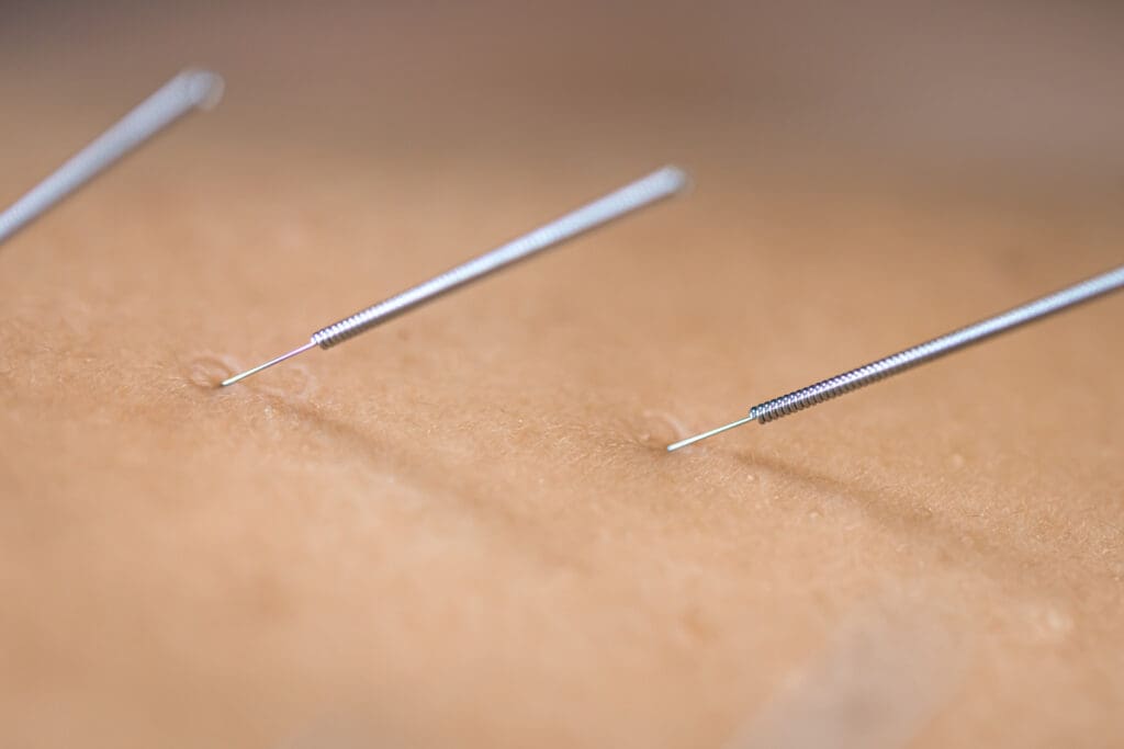 acupuncture acupuncture