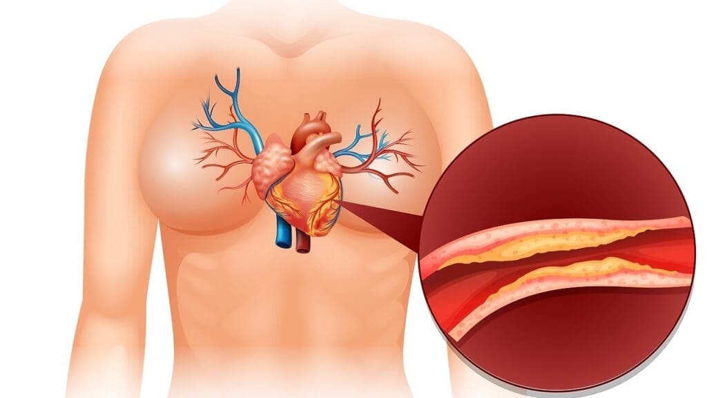 aneurysmal dilatation of the ascending aorta
