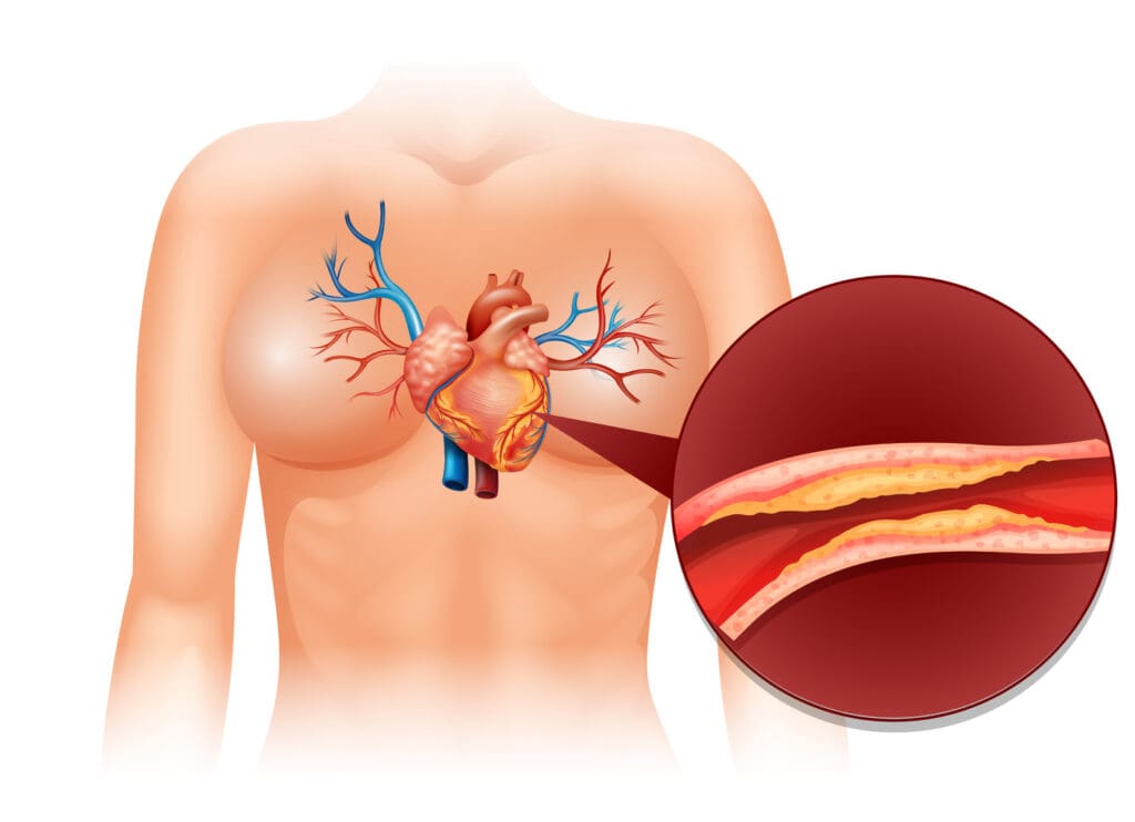 angina pectoris angina pectoris