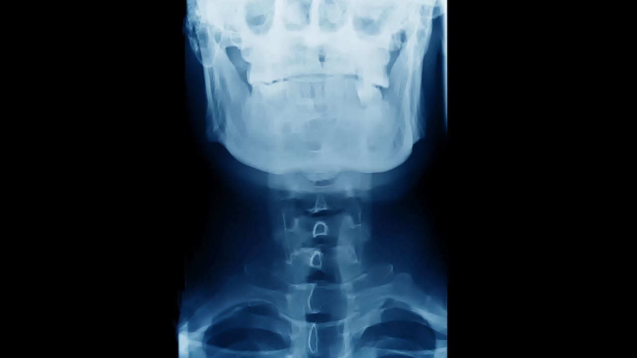 anterior cervical discectomy and fusion acdf