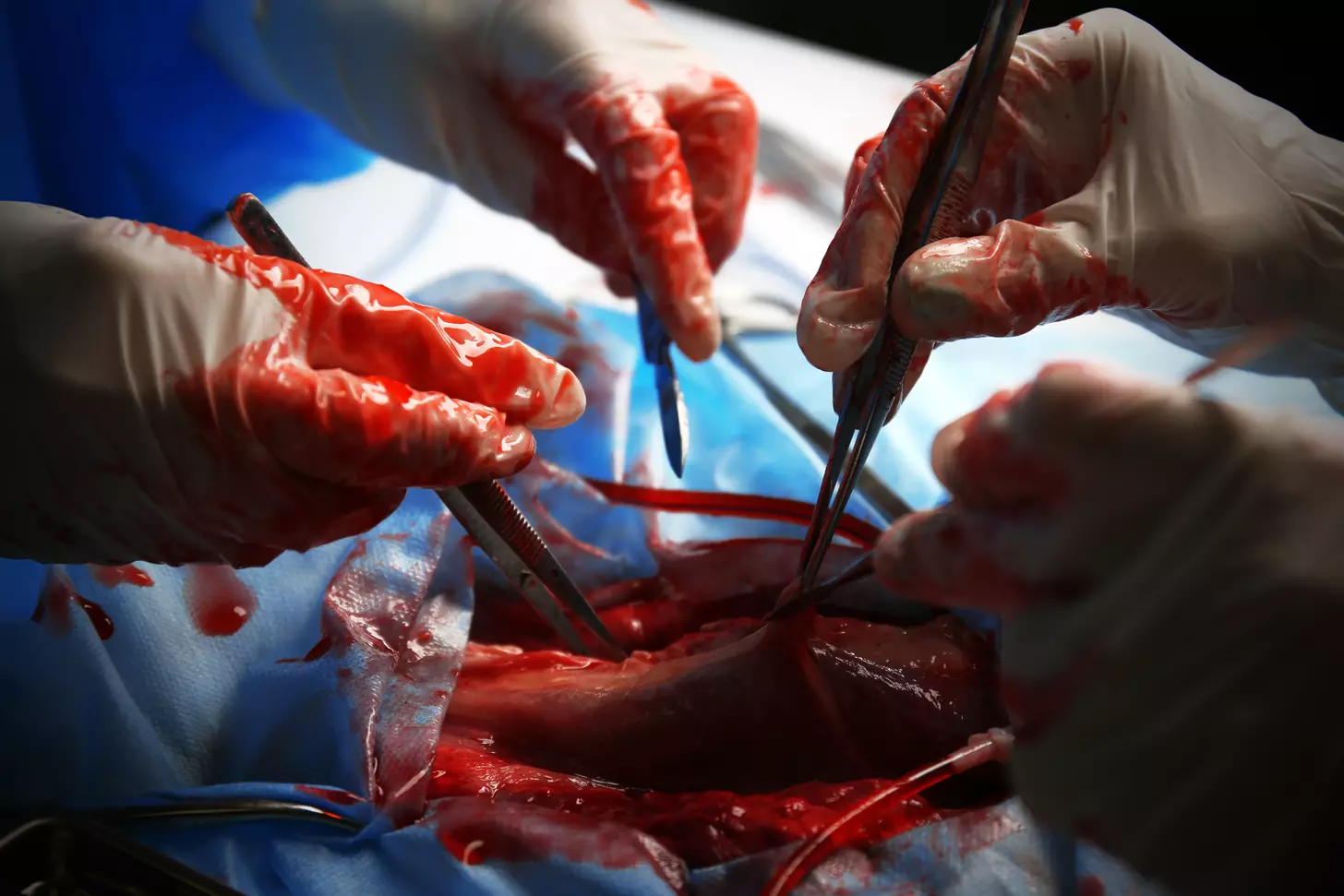 aorta surgery