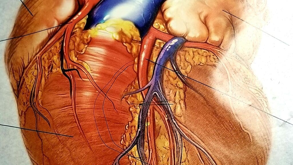 aortic valve calcification