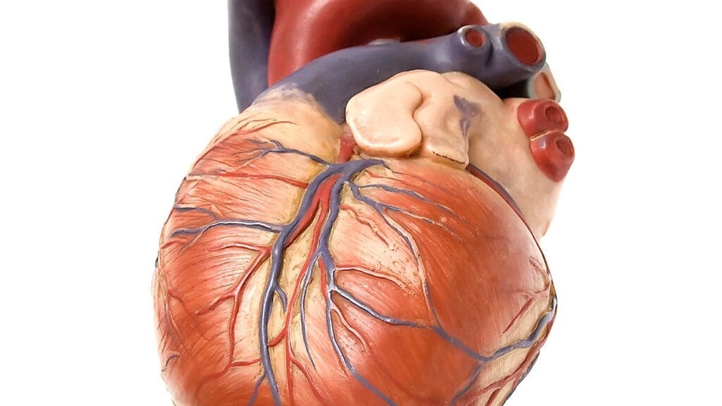 aortic valve with severe aortic calcification