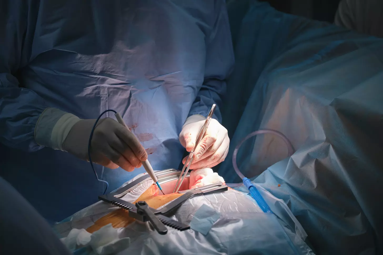ascending aortic aneurysm repair