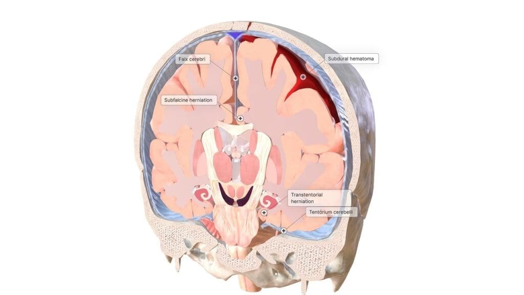 atherosclerosis cerebri