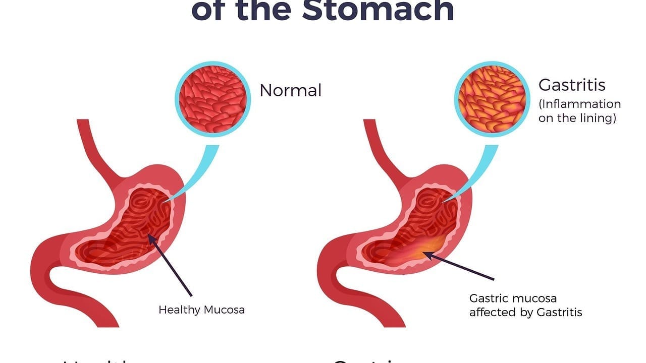 atherosclerotic abdominal aorta
