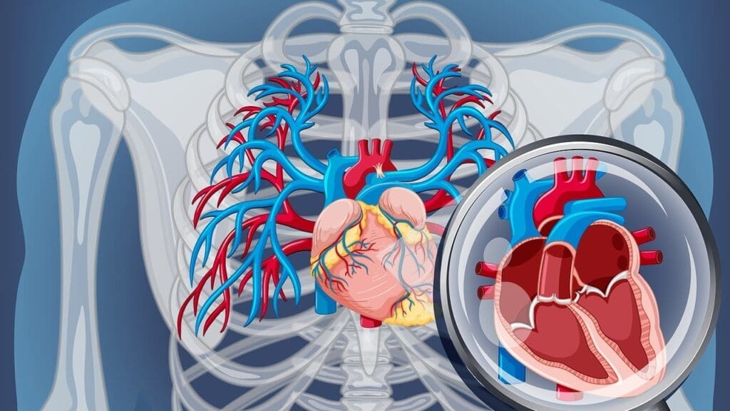 atherosclerotic plaque in the thoracic aorta