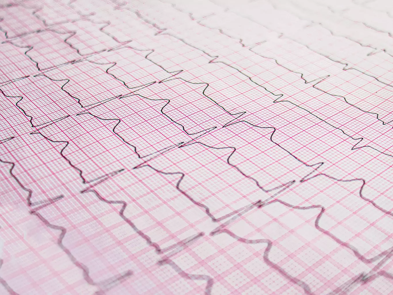 atrial fibrillation symptoms