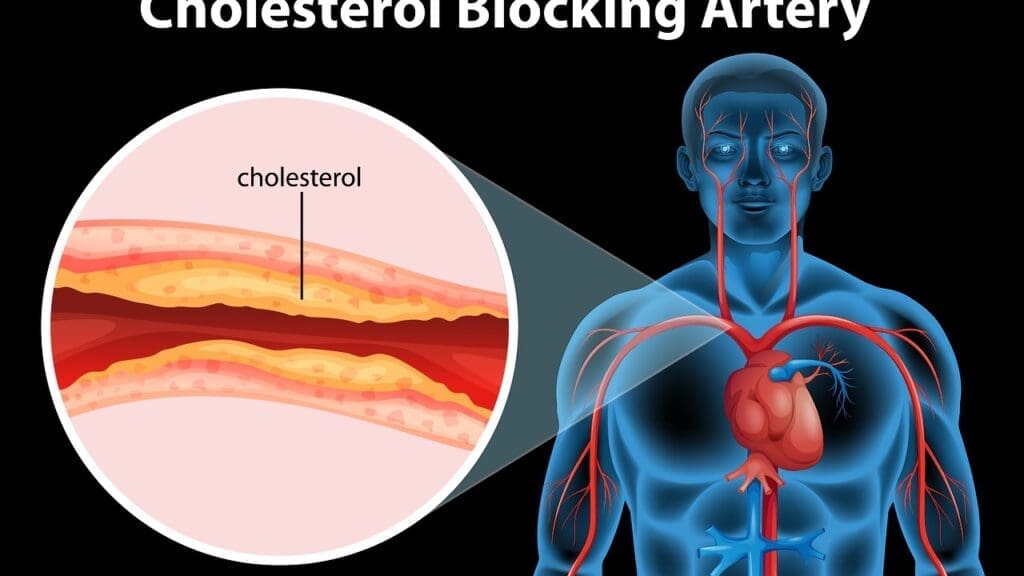 average artery blockage by age