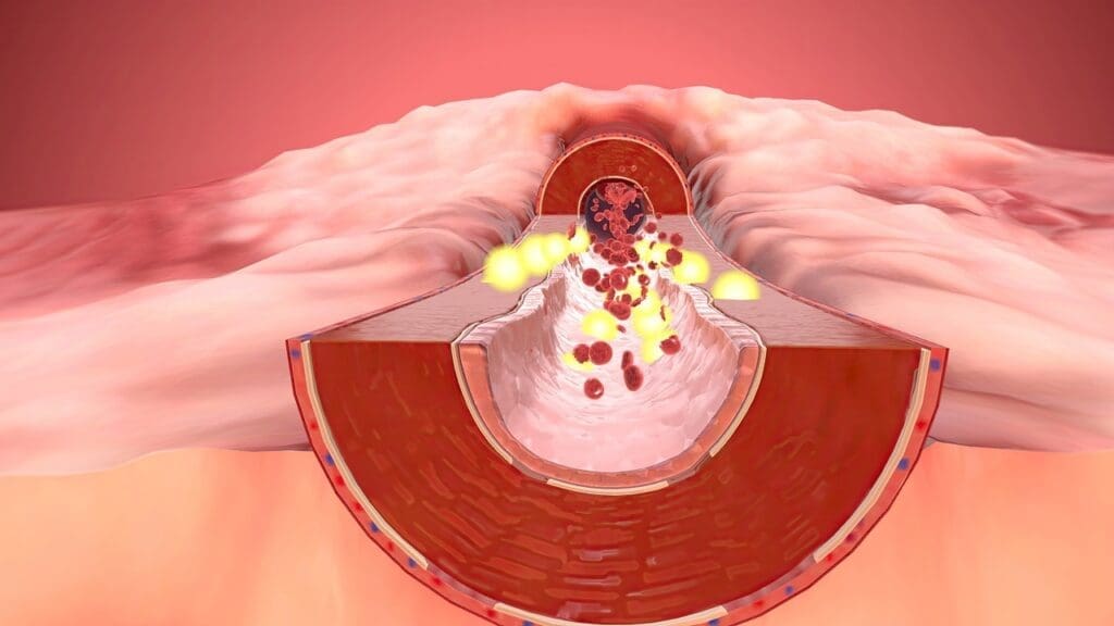 average artery blockage by age