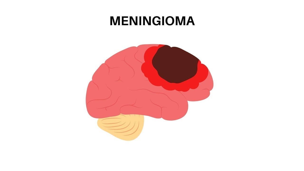average size of meningioma