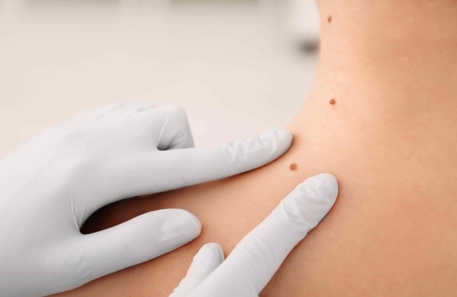 basal cell cancer tissue scraping