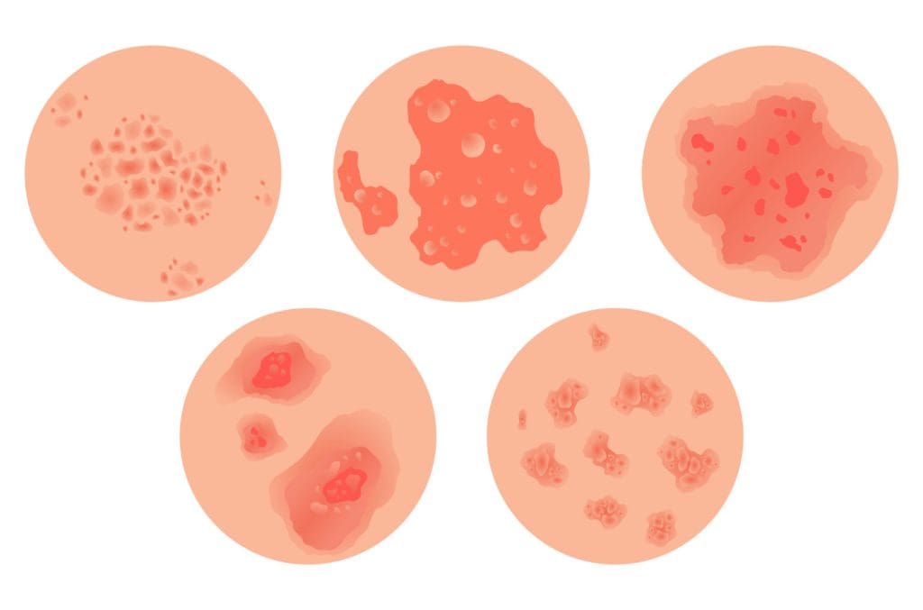 basal cell carcinoma and squamous cell carcinoma basal cell carcinoma and squamous cell carcinoma