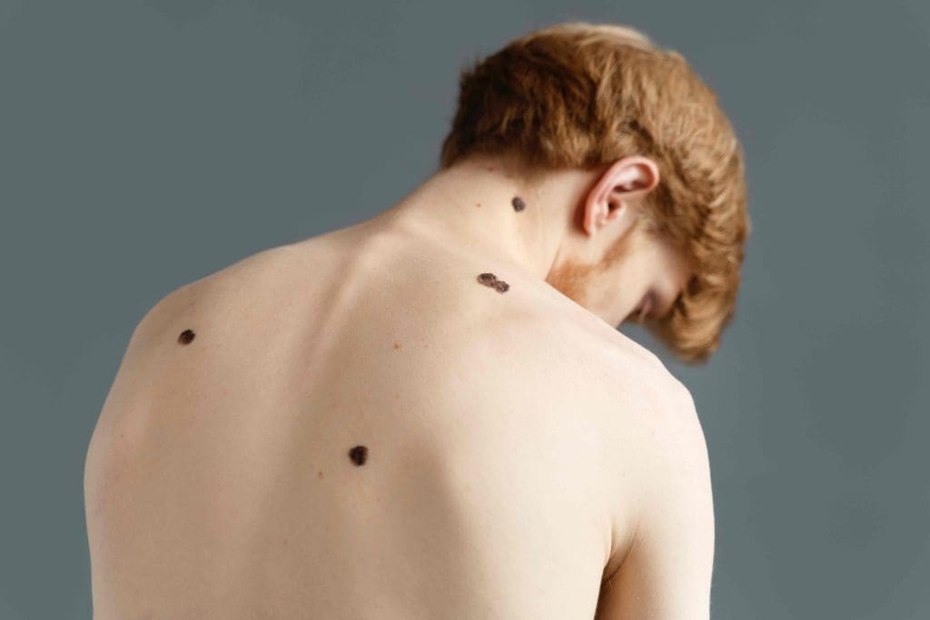 basal cell carcinoma on human skin