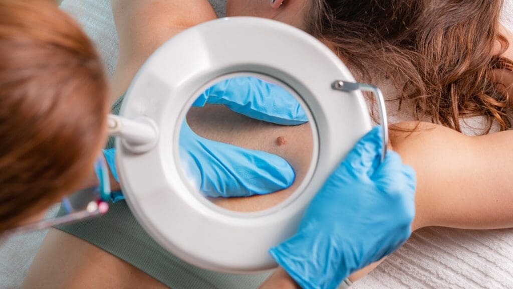 basal skin cancer removal