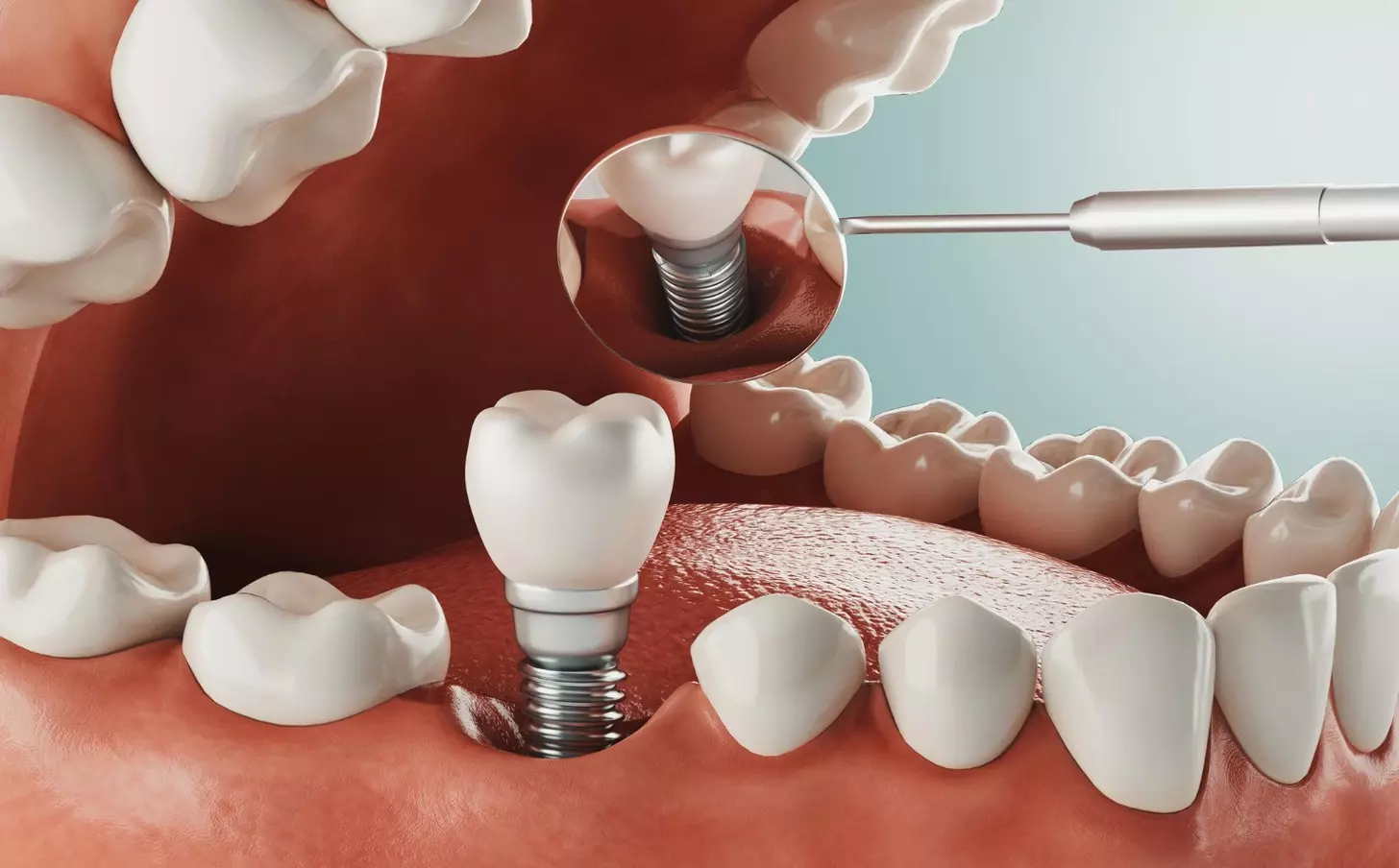 bone graft for implant