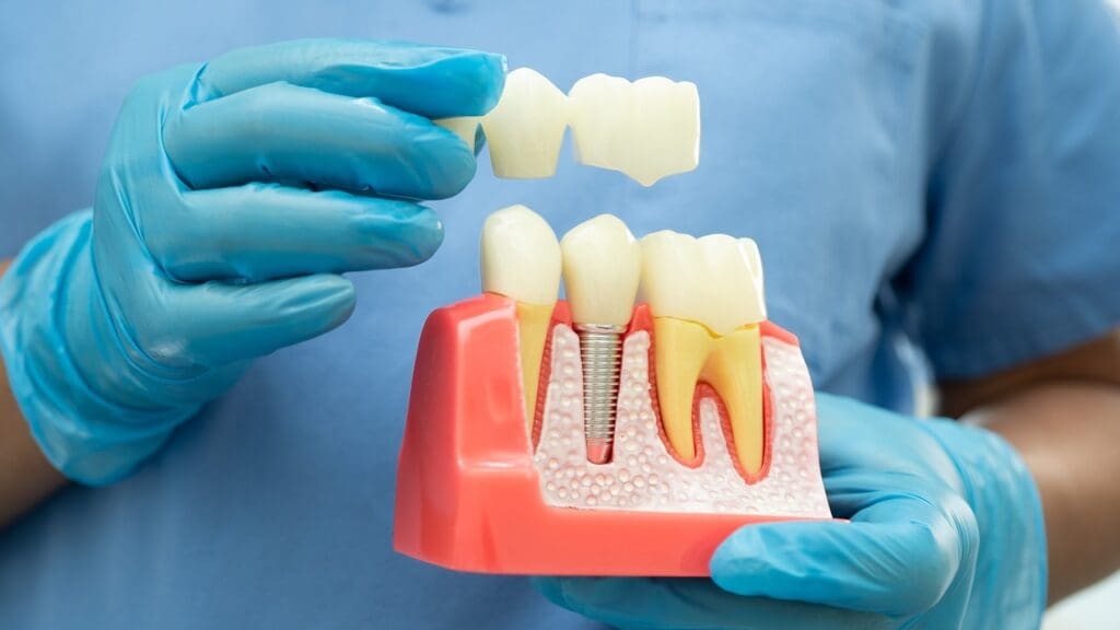 bone grafting for teeth