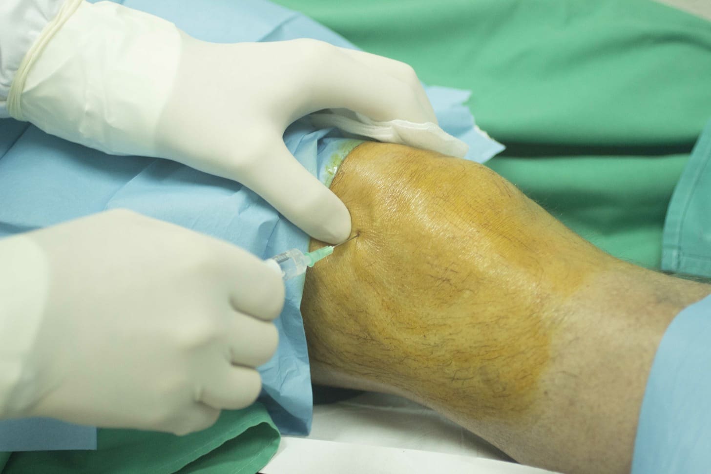 bone marrow aspiration recovery