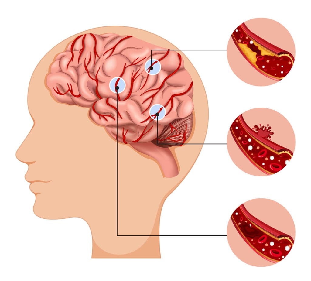 brain blood clot brain blood clot