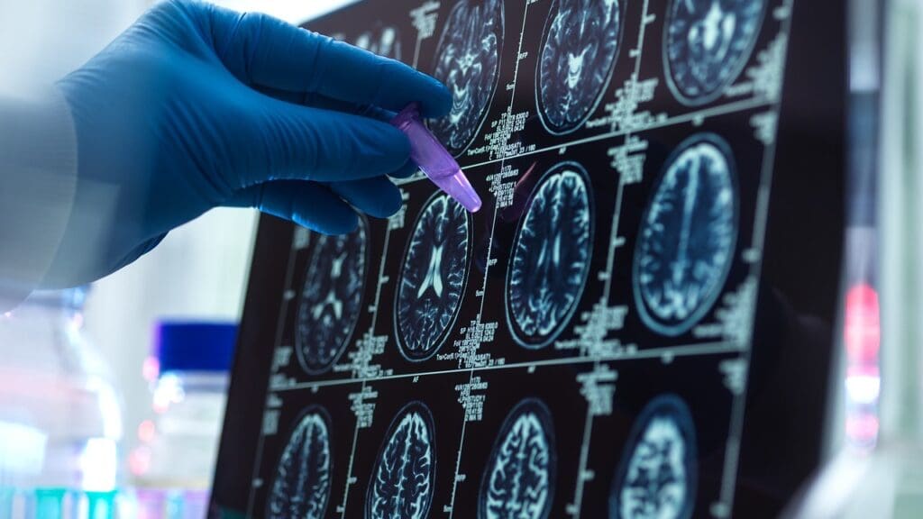 10 Brain Cancer Symptoms: How to Tell If It's a Tumor or Anxiety