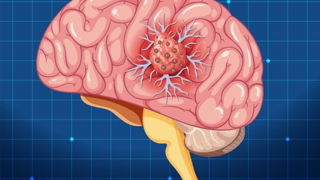 brain stem tumor prognosis factors