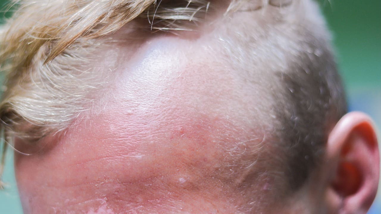 brain tumor rash