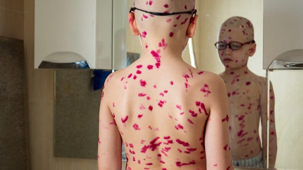 brain tumor skin rash