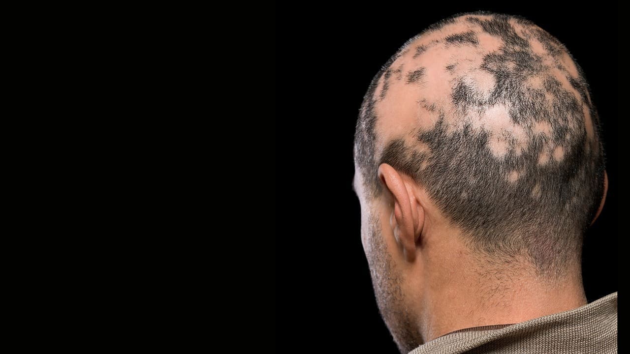 brain tumour hair loss