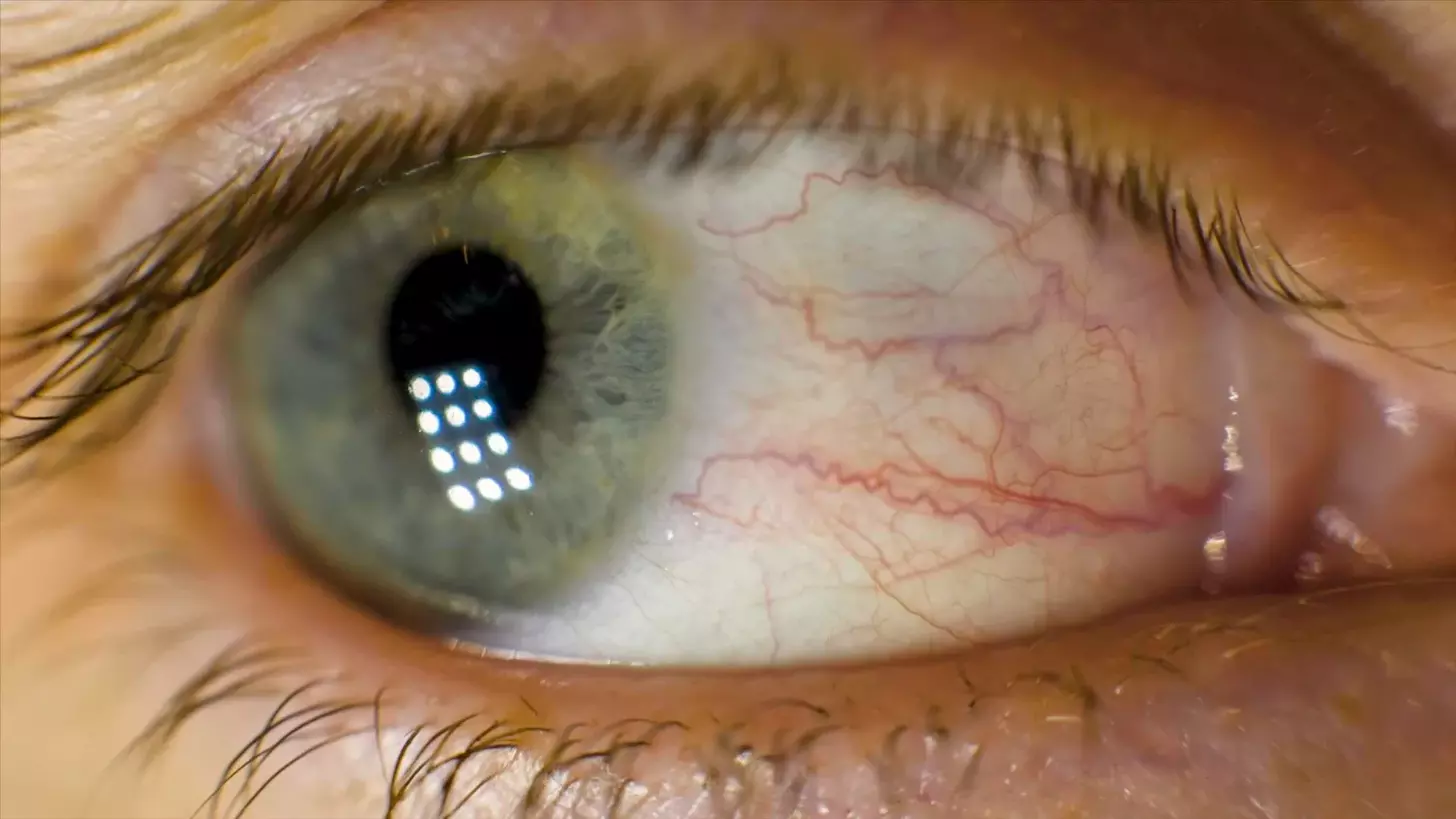 brain tumour vision changes