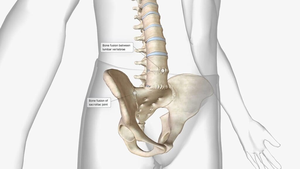 bulging disc vs herniated disc