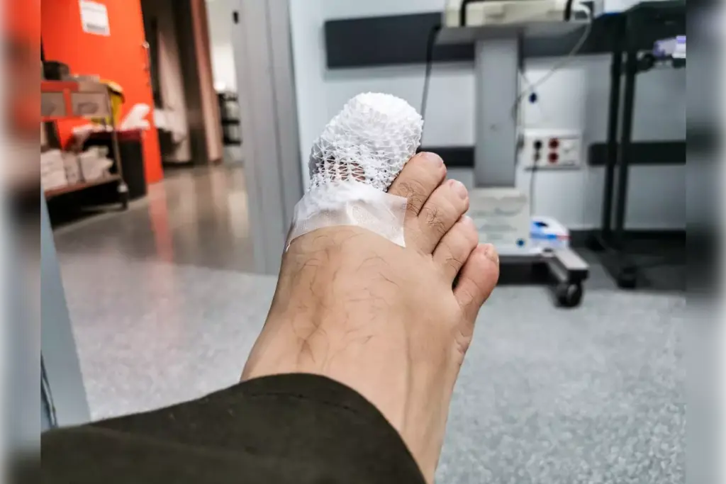 bunion operation recovery period