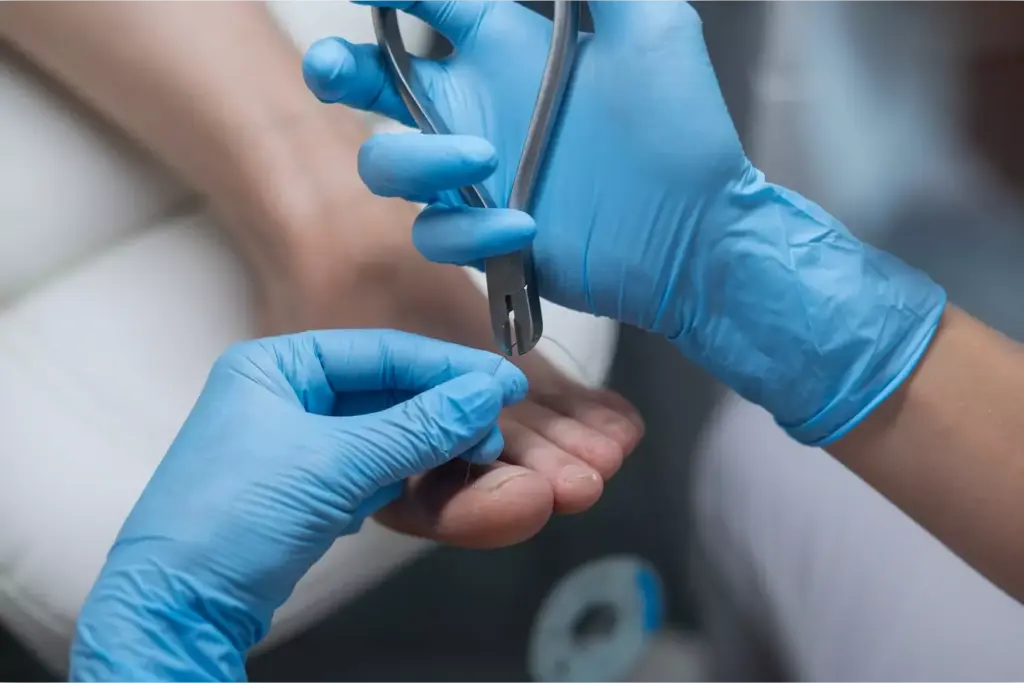 bunion recovery surgery