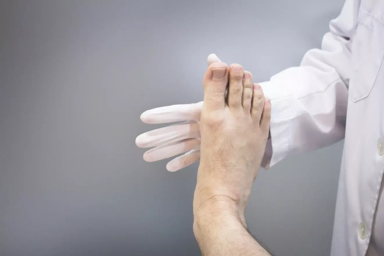 bunionectomy after surgery