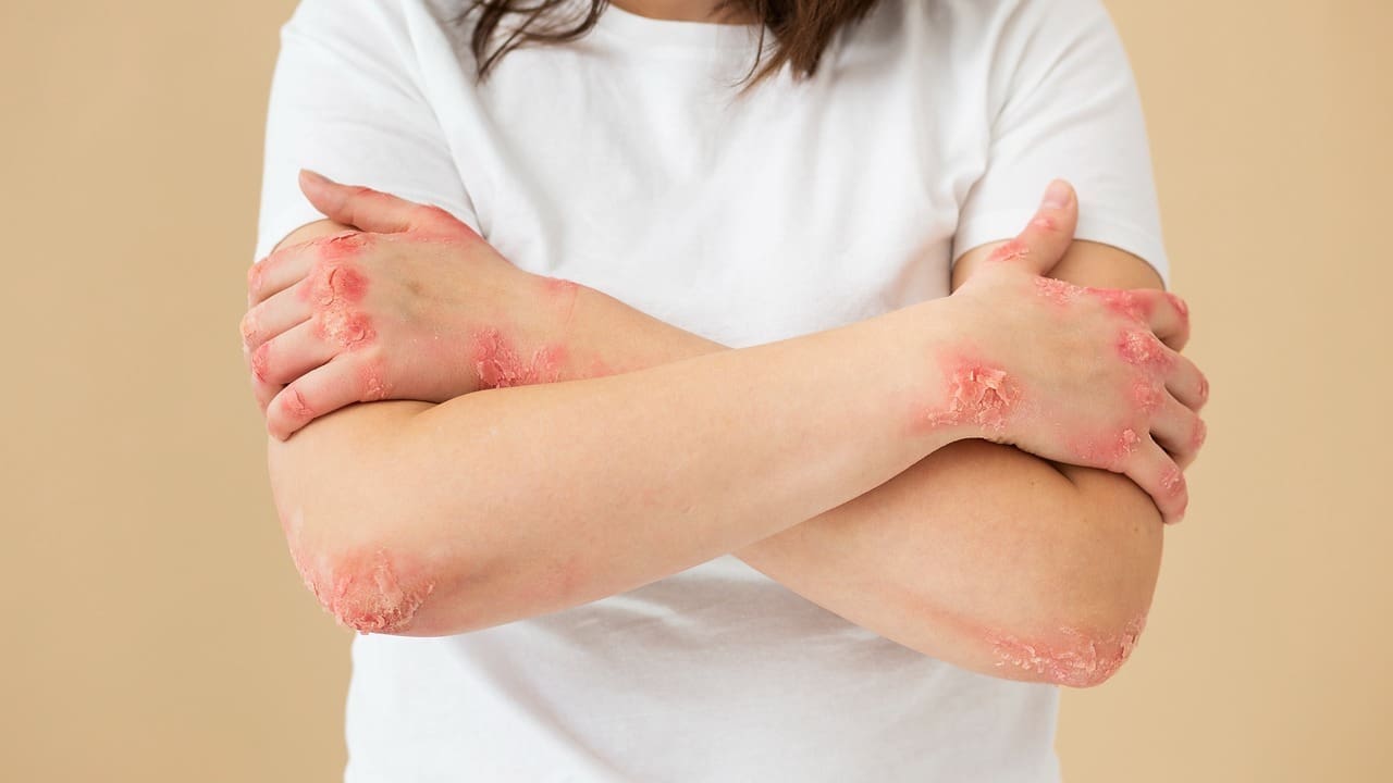 can immunotherapy cause autoimmune disease