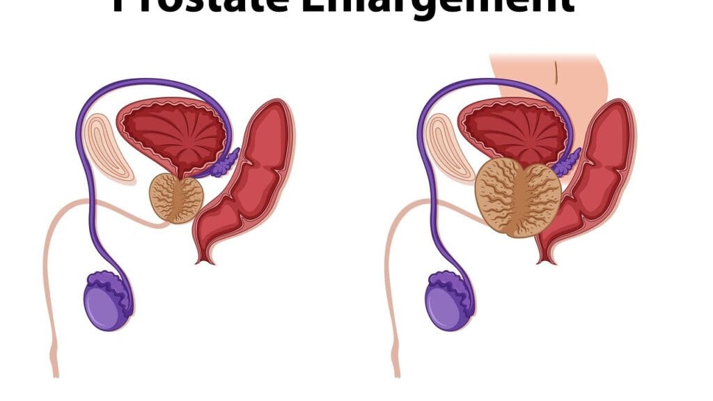 How Often Does Prostate Cancer Come Back After Prostate Removal Surgery?