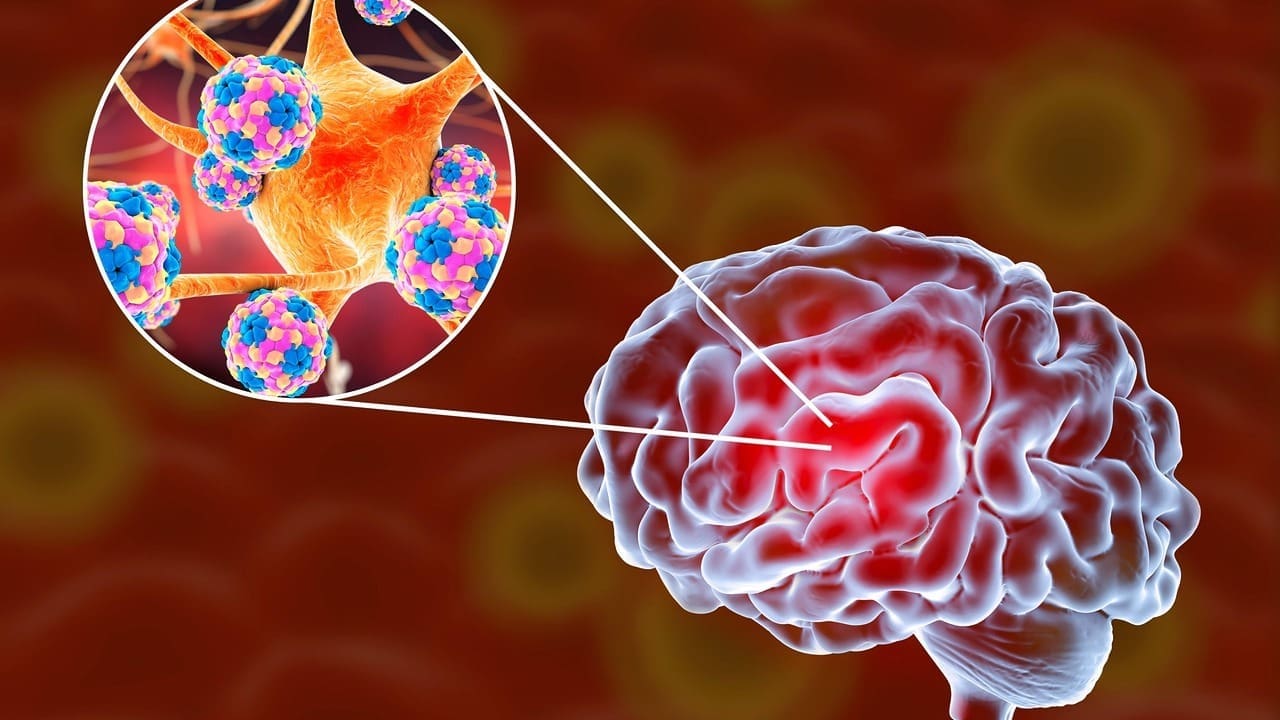 cancer of the brainstem