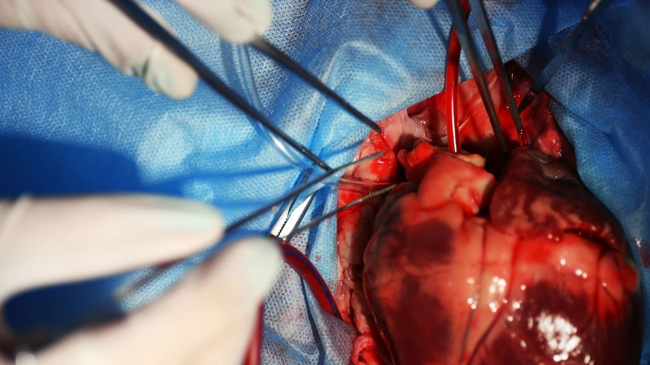 cardiac ring surgery