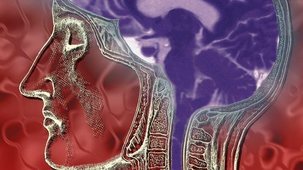 cerebral infarction pathophysiology