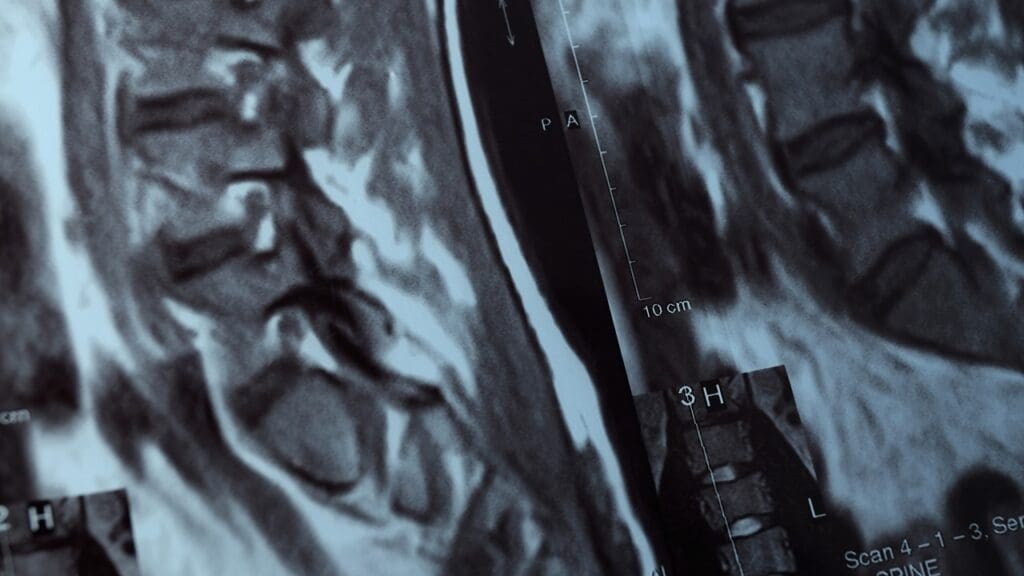 cervical spine fusion