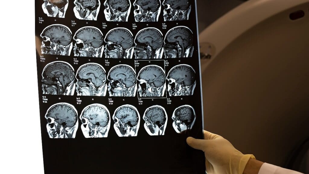choroid plexus cysts choroid plexus cysts