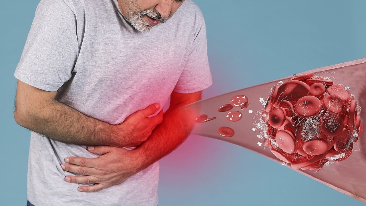 chronic graft versus host disease