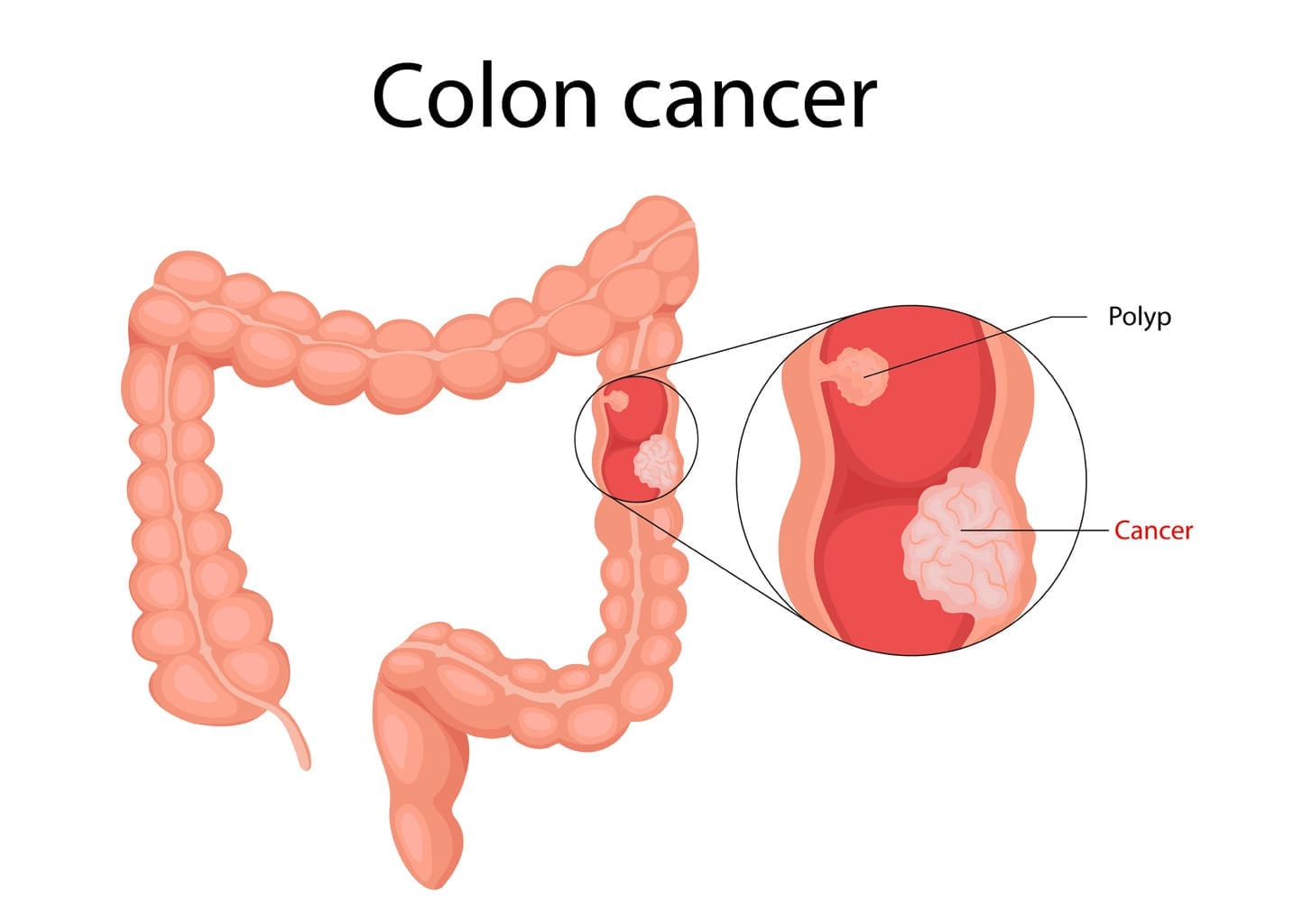 colon cancer